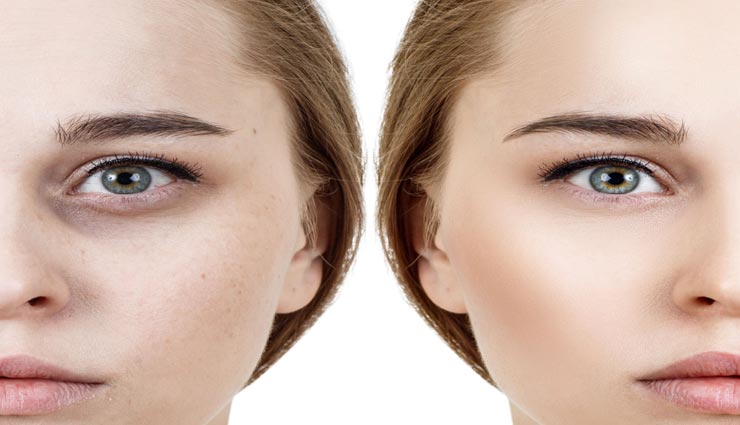 beauty tips,beauty tips in hindi,dark circles under the eyes,home remedies,dark circles remedies
