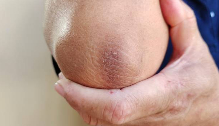 कोहनी का कालापन बन सकता हैं शर्मिंदगी का कारण, इन 7 तरीकों से करें समस्या को दूर 