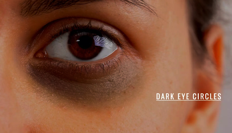 10 Effective Remedies To Help You Get Rid of Dark Eye Circles