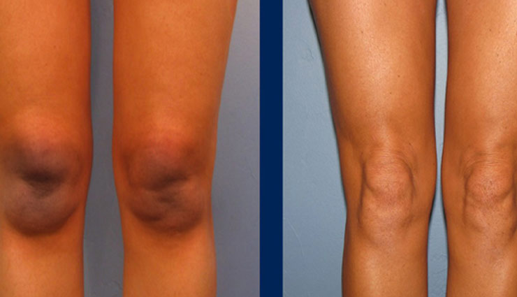 घुटनों के कालेपन से है परेशान, इन उपाय की मदद से पाए निजात 