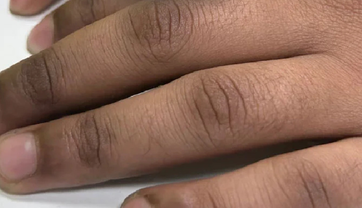 9 DIY Ways To Treat Dark Knuckles