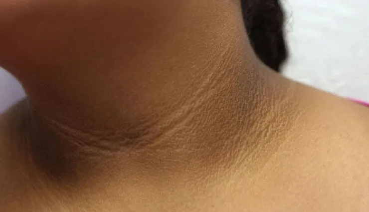 9 DIY Ways To Treat Dark Neck