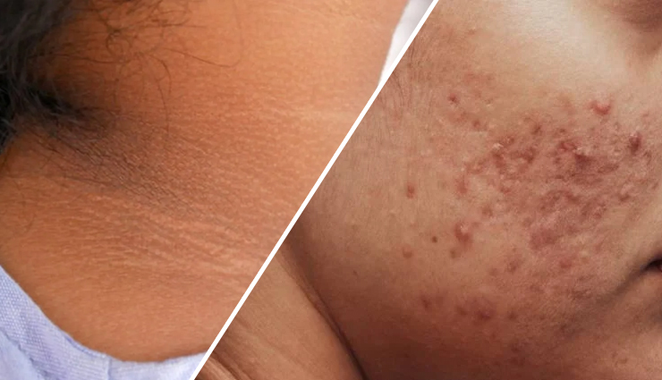 Suffering From Dark Neck or Acne, Try These 3 Effective Products