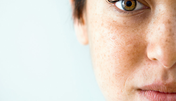 5 Home Remedies Helpful To Get Rid of Dark Spots
