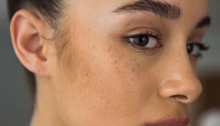 5 Things That Will Help You Get Rid of Dark Spots During Winters