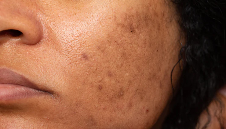 tea tree oil for acne,beauty benefits of tea tree oil,amazing benefits of tea tree oil for skin,tea tree oil acne treatment,natural remedy for acne: tea tree oil,clear skin with tea tree oil,how to use tea tree oil for acne,tea tree oil skincare for acne-prone skin,tea tree oil for clear and blemish-free skin,get rid of acne with tea tree oil