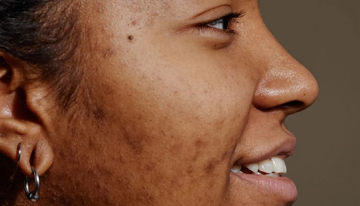 potato beauty benefits,potatoes for skin,potatoes for hair,potato juice for blemishes,natural skincare remedies,diy hair treatments,glowing skin tips,shiny hair home remedy,beauty hacks with potatoes,home remedies for skin,starchy vegetable skincare,natural beauty tips