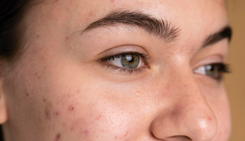 5 DIY Ways To Treat Dark Spots on Face