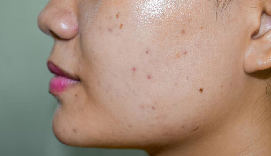 10 Effective Home Remedies To Treat Dark Spots on Face