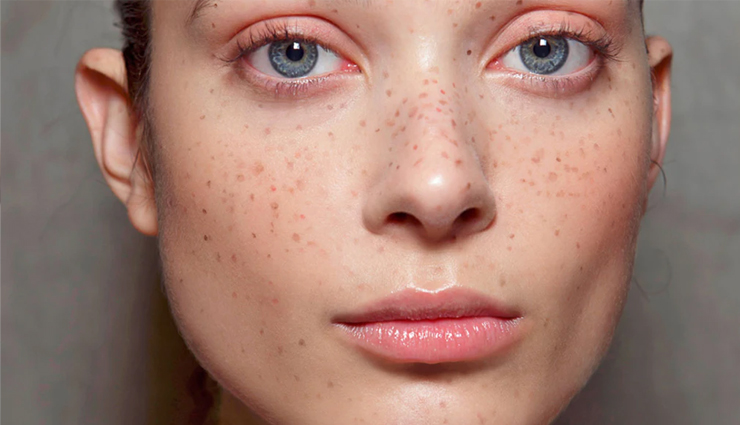 5 Amazing Ways To Get Rid of Dark Spots