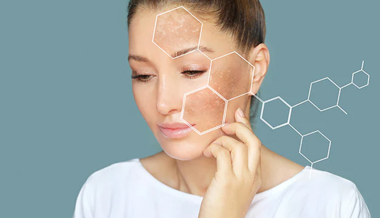 5 Must Try Remedies to Treat Dark Spots on Face