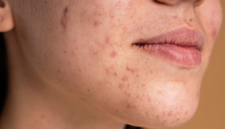 diy tomato pulp remedies,tomato pulp for acne,tomato pulp for glowing skin,tomato pulp skincare recipes,benefits of tomato pulp for skin,natural skin treatments with tomato,tomato pulp for oily skin,tomato pulp face treatments,home remedies with tomato pulp,tomato pulp for dark spots