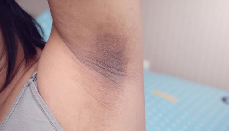 8 DIY Ways To Treat Dark Armpits at Home