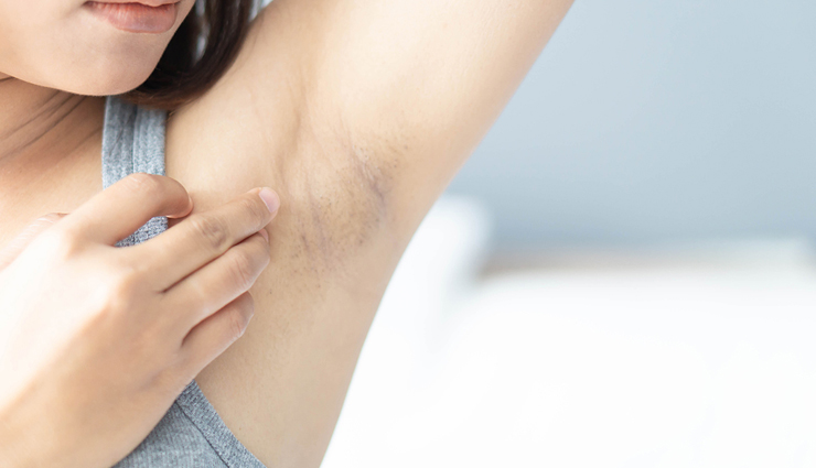 5 Natural Remedies To Lighten Dark Underarms