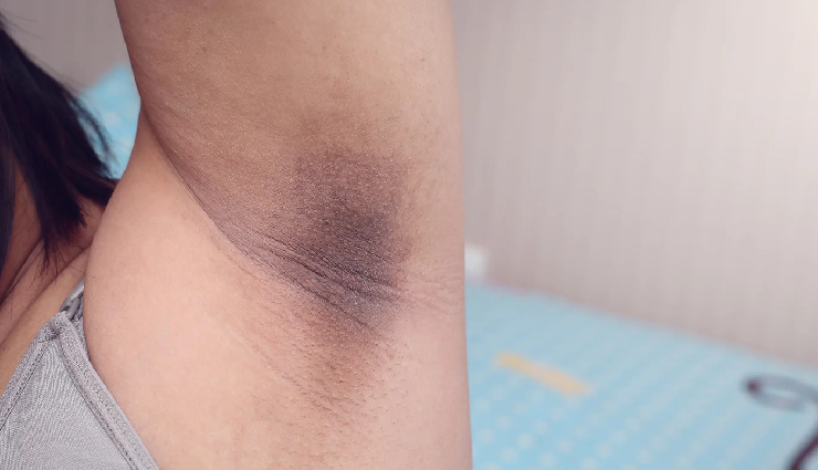 6 DIY Masks To Help You Lighten Dark Underarms