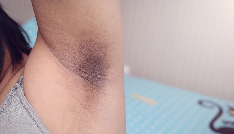 6 Effective Home Remedies To Treat Dark Underarms