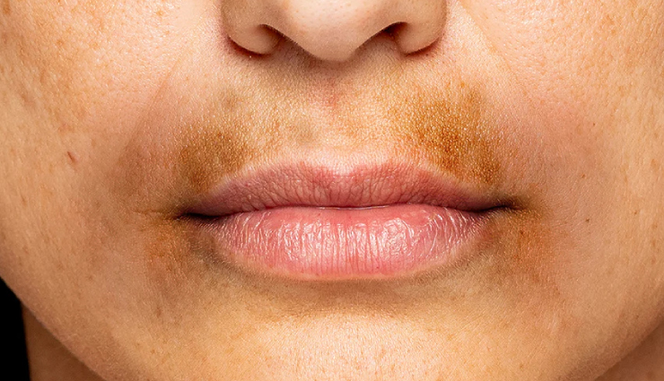 5 Beauty Tips To Treat Darkness Around Mouth and Lips
