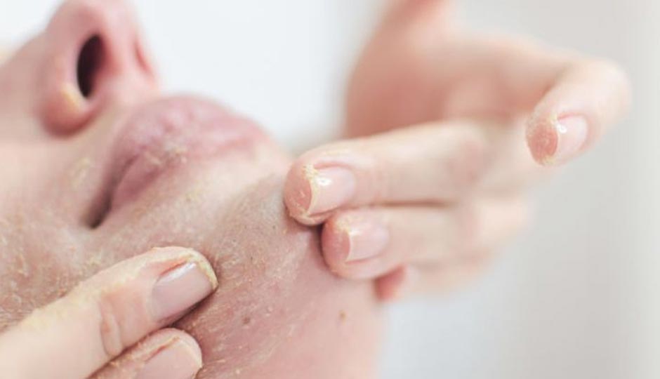 5 Effective Home Remedies To Remove Dead Skin