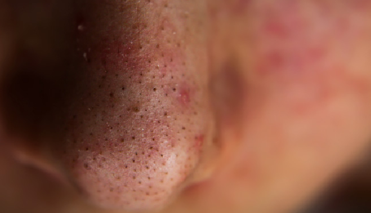 4 Must Try Remedies To Remove Deep Blackheads