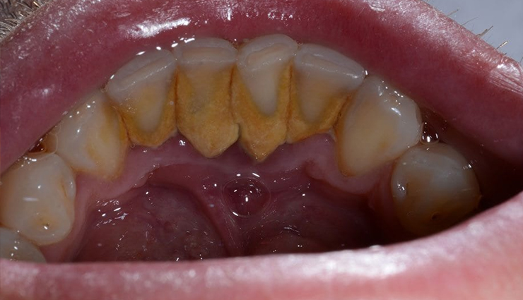 आम बात है मुँह का कैंसर होना, समय रहते किए गए इलाज से बचाया जा सकता है स्वयं को mouth cancer causes,oral cancer risk factors,tobacco and mouth cancer,alcohol and oral cancer,hpv and mouth cancer,sun exposure and lip cancer,unhealthy diet and mouth cancer,chewing tobacco and oral cancer,mouth cancer prevention,oral health and cancer development