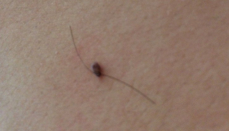 skin tags,home remedies to treat skin tags,skin care,skin beauty,skin care tips,beauty tips