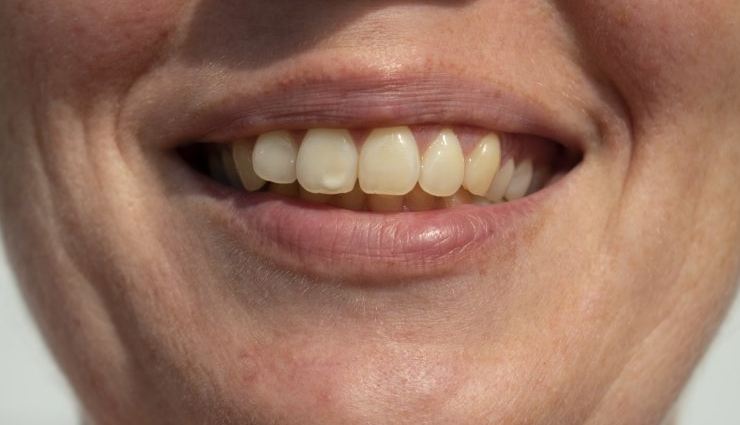 5 Home Remedies To Treat Dental Fluorosis