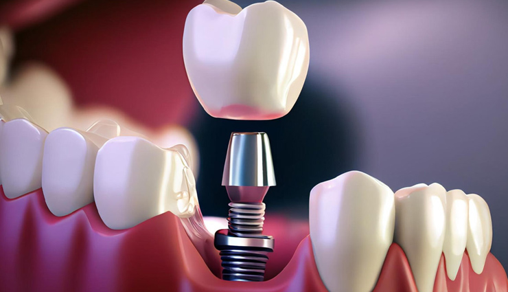 6 Tips To Help you Avoid Dental Implant Failure