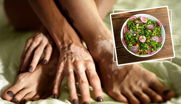 World Vitiligo Day 2023: Diet Tips for Vitiligo - Foods to Eat