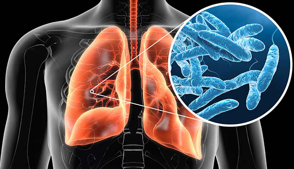Legionnaires' Disease Outbreak- What You Need to Know