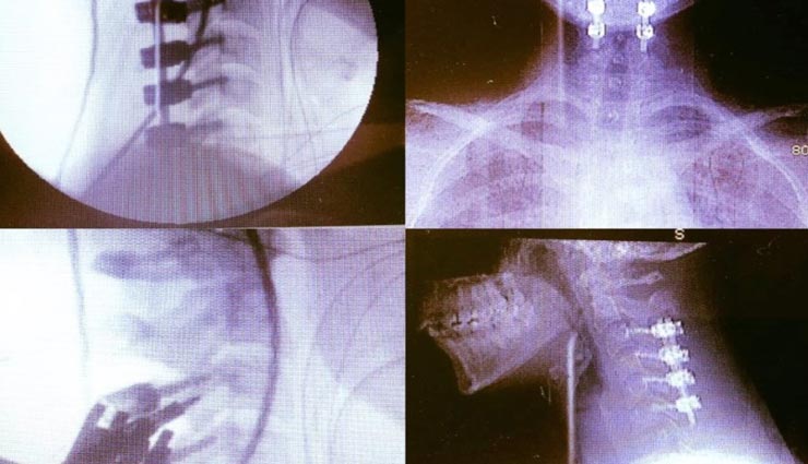 अनोखी बिमारी के चलते बना गर्दन टूटने का डर, जानकारी बेहद डराने वाली weird disease,disease related to neck pain,samtha smith,ehlers danlos syndrome