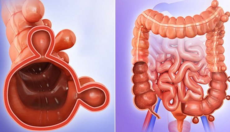 8 Effective Remedies To Treat Diverticulitis at Home