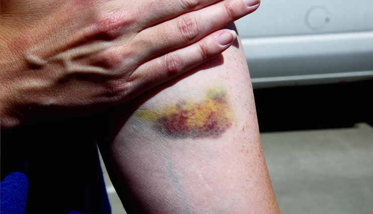 natural remedies for bruise,home remedies for bruise,how to lighten bruises naturally,home remedies for bruise discoloration,bruise healing remedies at home,remedies to reduce bruising,bruise treatment home remedies,quick home remedies for bruises,home remedies for painful bruises,bruise remedy with natural ingredients,home remedies to speed up bruise healing