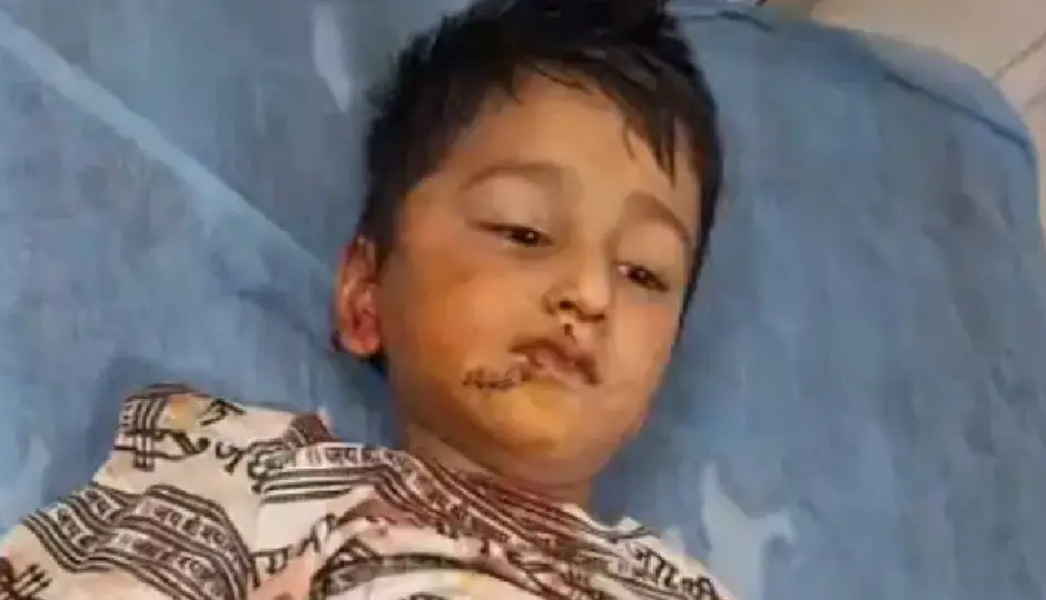 राजस्थान में दिल दहला देने वाली घटना, घर के बाहर खेल रहे 5 साल के बच्चे पर आवारा कुत्ते का हमला, चेहरे और कान पर लगे 20 टांके