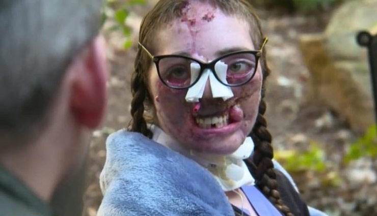 dog,dog bitten girl,german shepherd,pitbull