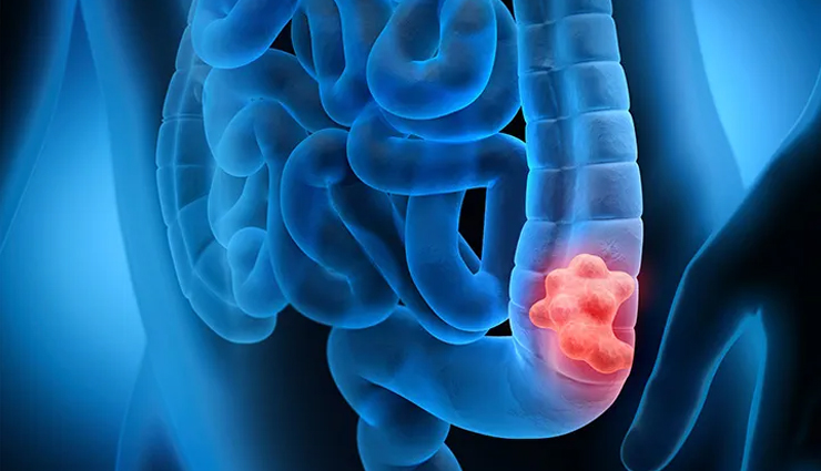 health benefits of dried figs,dried figs,Health tips,fitness tips