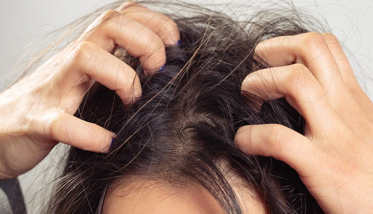 10 Effective Remedies for Treating Dry, Itchy Scalp