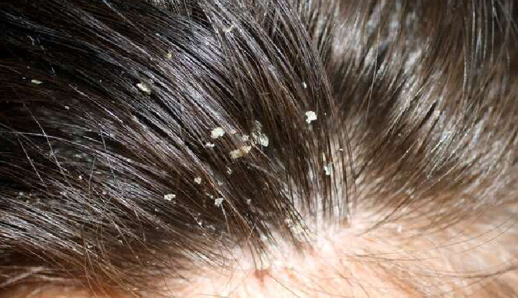 types of dandruff,dry scalp dandruff,oily scalp dandruff,fungal dandruff,psoriasis dandruff,seborrheic dermatitis,types of scalp conditions,dandruff causes,scalp health awareness,dandruff prevention tips