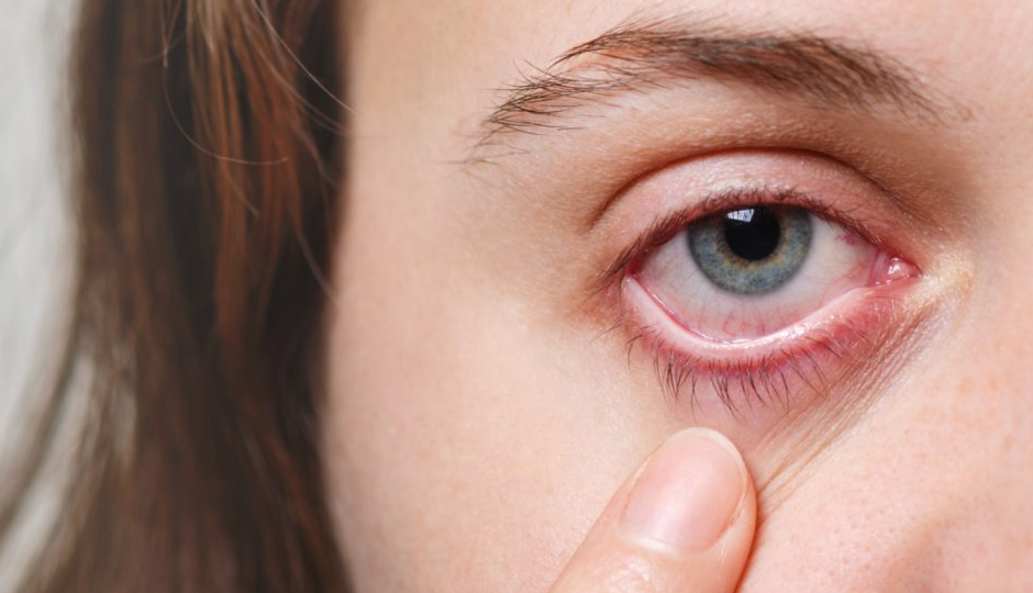 10 Effective Home Remedies To Treat Dry Eye
