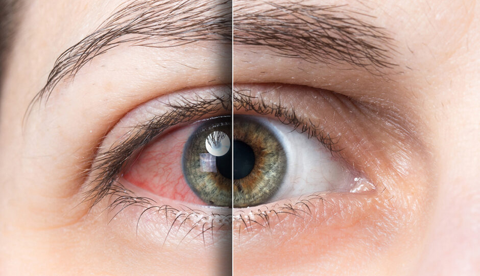 10 Effective Home Remedies To Treat Dry Eyes