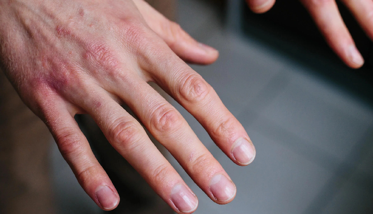 5 Effective Remedies to Treat Dry Hands Naturally