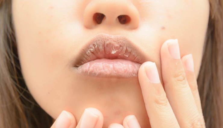 5 Effective Homemade Tips To Treat Dry Lips