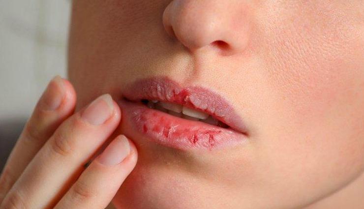 8 Must Try Home Remedies To Treat Dry Lips