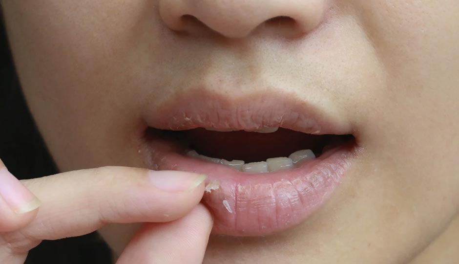 6 Amazing Home Remedies to Treat Dry Lips
