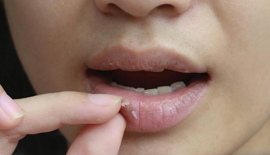 7 DIY Ways To Treat Dry Lips in Summers