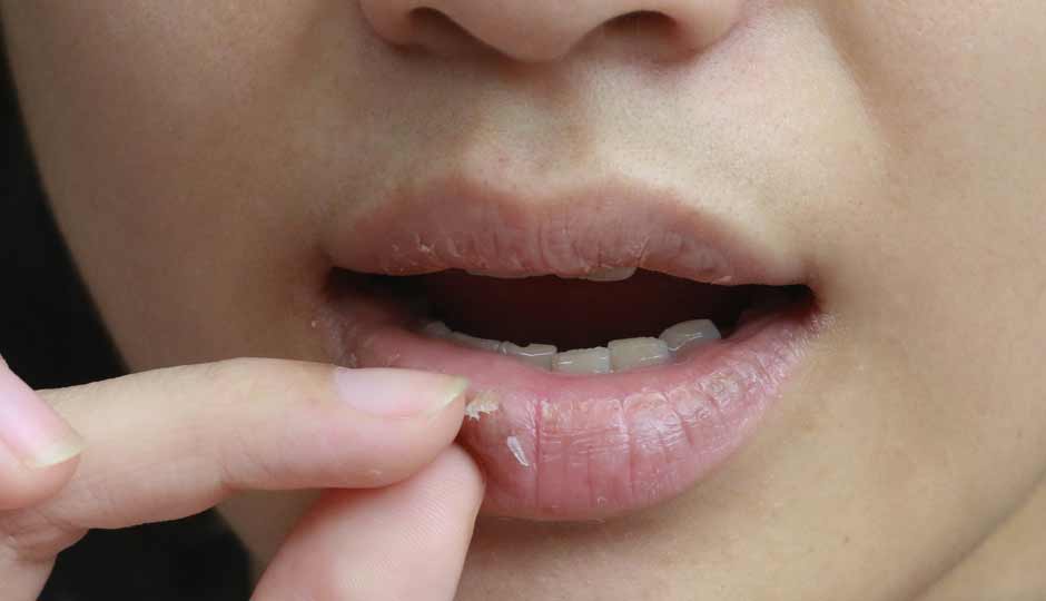 12 DIY Ways to Treat Dry Lips in Monsoon