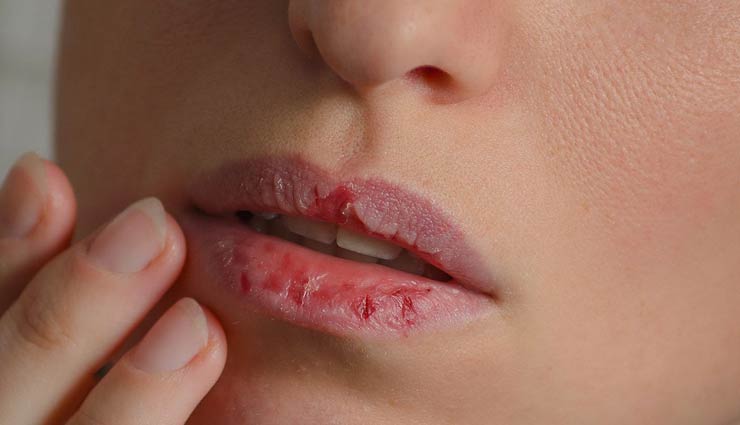 homemade tips,homemade tips to treat dry lips,dry lips,lip care tips,beauty tips,skin care tips