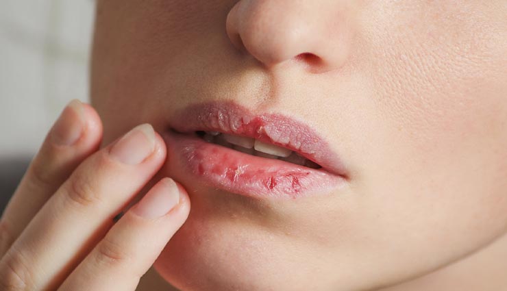 ठण्ड में सताती हैं ड्राई लिप्स की समस्या, ये 3 प्राकृतिक उपाय दिलाएंगे राहत