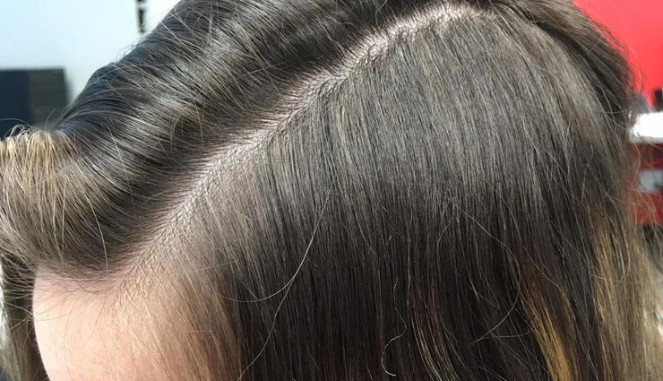 dry scalp,home remedies,home remedies to treat dry scalp,hair care tips,beauty tips