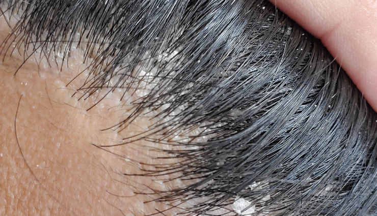 cedarwood essential oil benefits for skin,cedarwood essential oil for hair growth,benefits of cedarwood oil for scalp,cedarwood oil for dandruff and itchy scalp,cedarwood oil for acne-prone skin,cedarwood oil for oily skin,cedarwood oil for dry skin,cedarwood oil for eczema and psoriasis,natural remedies for hair loss with cedarwood oil,anti-inflammatory benefits of cedarwood essential oil