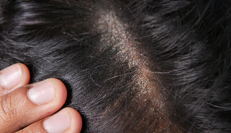 6 DIY Ways To Treat Dry Scalp